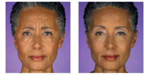 Botox before and after photography from Dignity Medical