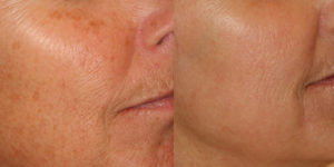 Rejuvenating skin treatment before & after photo at Dignity Medical