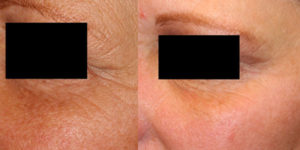 Before & After photo of Rejuvenating skin treatment at Dignity Medical