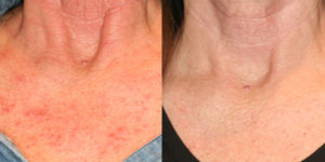 Before and after photo of Rejuvenating skin treatment at Dignity Medical Aesthetics