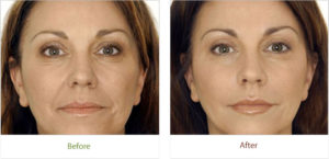 Before and after photography of Botox treatments from Dignity Medical