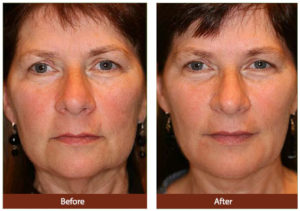 Before and after photo of Liquid Facelift treatment at Dignity Medical Aesthetics