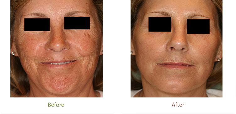 3D Rejuvenation treatment before and after photo at Dignity Medical Aesthetics