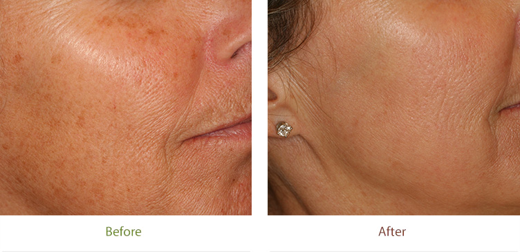 3D Rejuvenation treatment before and after photo at Dignity Medical Aesthetics