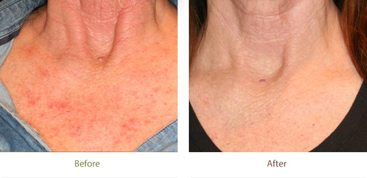 3D Rejuvenation treatment before and after photo at Dignity Medical Aesthetics