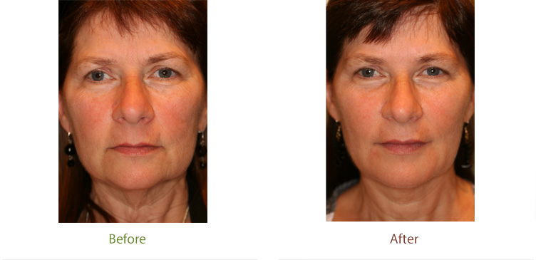 Liquid facelift treatment before and after photo at Dignity Medical Aesthetics