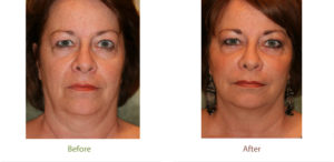 Before & After photo of liquid facelift treatment at Dignity Medical