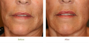 Liquid facelift treatment before and after photo at Dignity Medical Aesthetics