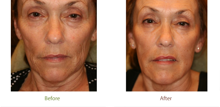 Liquid facelift treatment before and after photo at Dignity Medical Aesthetics
