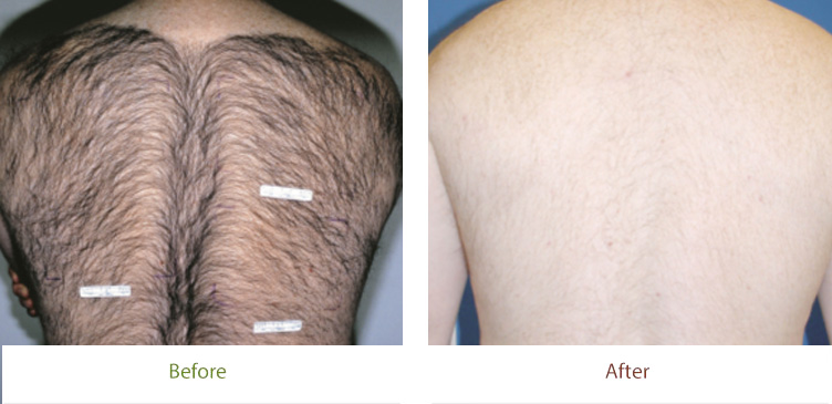 Laser Hair Reduction treatment before & after photo at Dignity Medical