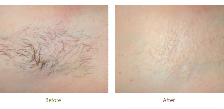 Before & After photo of Laser Hair Reduction treatment at Dignity Medical