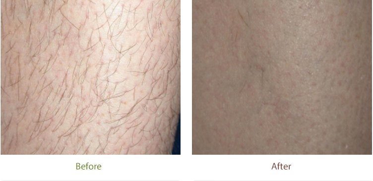 Before & After photo of Laser Hair Reduction treatment at Dignity Medical