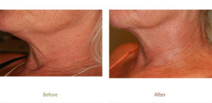 Before & After photo of Laser Skin Tightening treatment at Dignity Medical