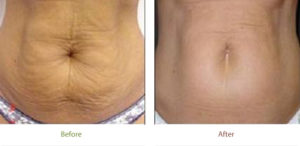 Before and after photo of Laser Skin Tightening treatment at Dignity Medical Aesthetics