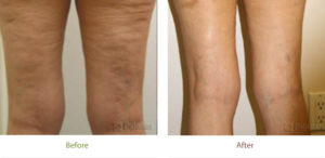 Laser Skin Tightening treatment before & after photo at Dignity Medical