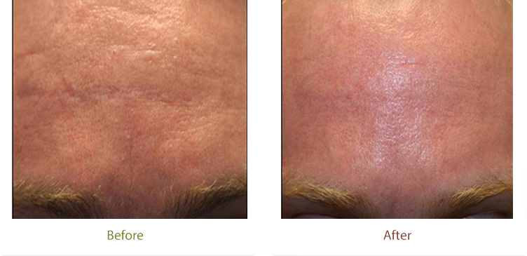 Before and after photo of skin resurfacing treatment at Dignity Medical Aesthetics