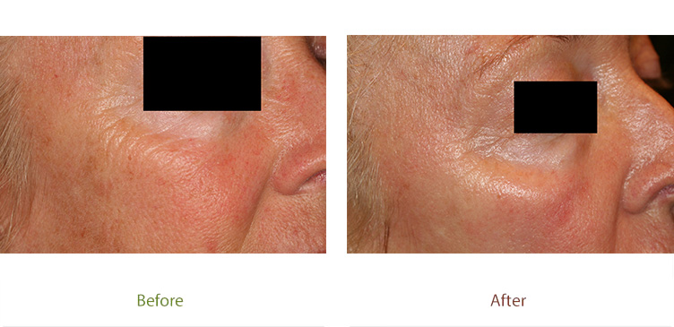 Skin resurfacing treatment before & after photo at Dignity Medical