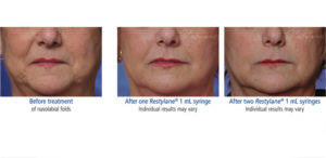 Before & After photo of Restylane treatment at Dignity Medical