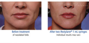 Restylane treatment before and after photo at Dignity Medical Aesthetics