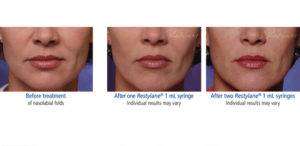 Restylane treatment before & after photo at Dignity Medical