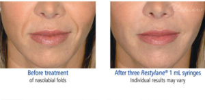 Restylane treatment before & after photo at Dignity Medical