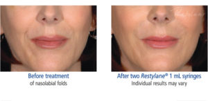 Restylane treatment before and after photo at Dignity Medical Aesthetics