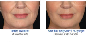 Restylane treatment before and after photo at Dignity Medical Aesthetics