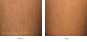 Before and after photo of Spider vein treatment at Dignity Medical Aesthetics