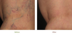 Spider vein treatment before and after photo at Dignity Medical Aesthetics