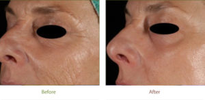 Ablative treatment before & after photo at Dignity Medical