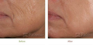 Ablative treatment before and after photo at Dignity Medical Aesthetics