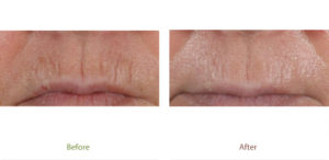 Before & After photo of Ablative treatment at Dignity Medical