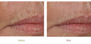 Before & After photo of Ablative treatment at Dignity Medical