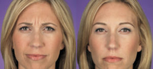 Botox before and after photo at Dignity Medical Aesthetics
