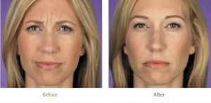 Botox before and after photo at Dignity Medical