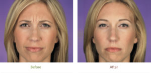 Before and after photo with Botox at Dignity Medical