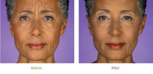 Botox before and after photo at Dignity Medical Aesthetics