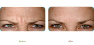 Dysport treatment before & after photo at Dignity Medical