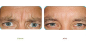Before and after photo of Dysport treatment at Dignity Medical Aesthetics