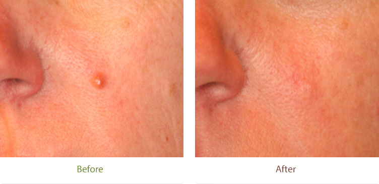 Mole removal treatment before & after photo at Dignity Medical