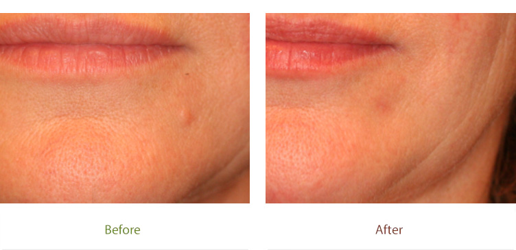 Mole removal treatment before & after photo at Dignity Medical