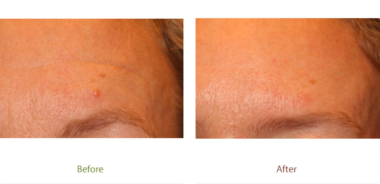 Mole removal treatment before & after photo at Dignity Medical