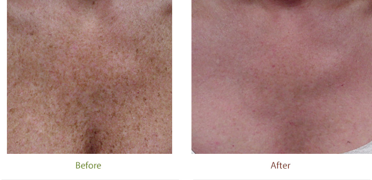 Before and after photo of photofacial treatment at Dignity Medical Aesthetics