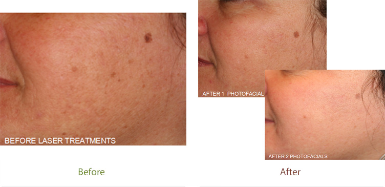 Photofacial treatment before and after photo at Dignity Medical Aesthetics