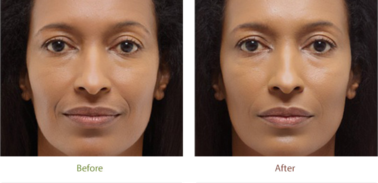 Radiesse treatment before & after photo at Dignity Medical