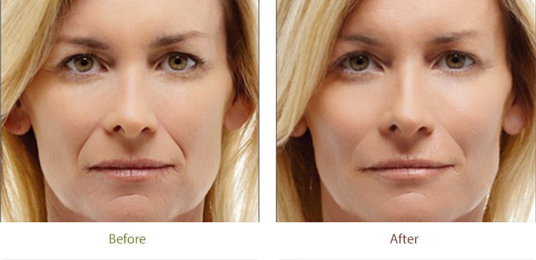 Radiesse treatment before and after photo at Dignity Medical Aesthetics