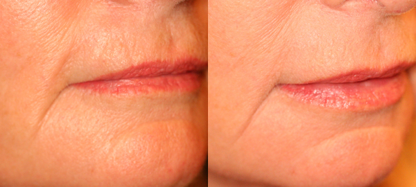 Before and after photo of a Belotero treatment at Dignity Medical Aesthetics Before and after photo of a Belotero treatment at Dignity Medical Aesthetics