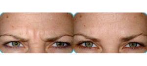 Before & After Dysport treatment at Dignity Medical Aesthetics