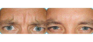 Dysport treatment before and after photos at Dignity Medical Aesthetics