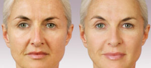 Before and after photo of a Juvederm treatment at Dignity Medical Aesthetics